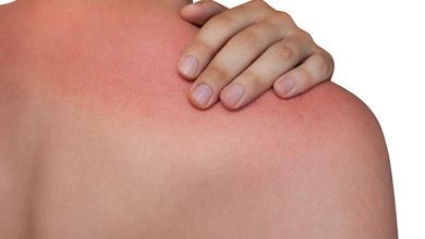 Sunburn problems – Easy tips to help your skin recover without peeling and blemishes