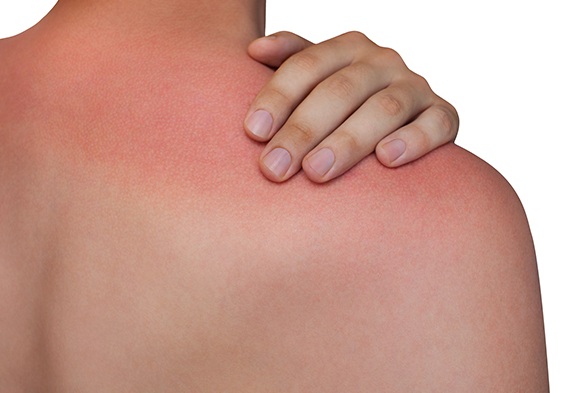 Sunburn problems – Easy tips to help your skin recover without peeling and blemishes